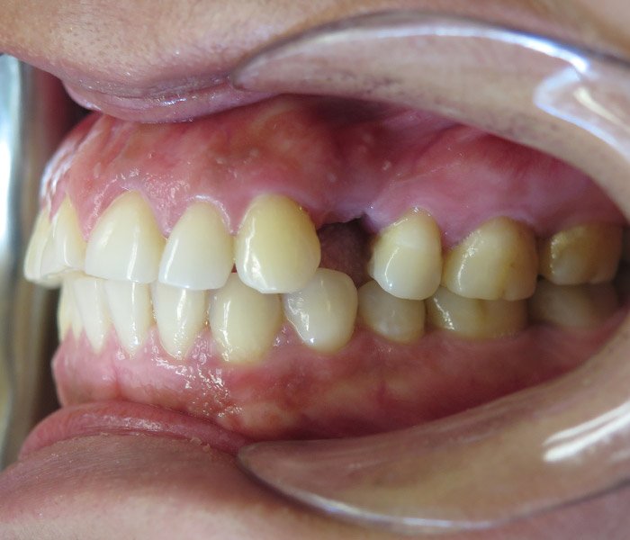 Before And After Photos Of Real Dental Patients